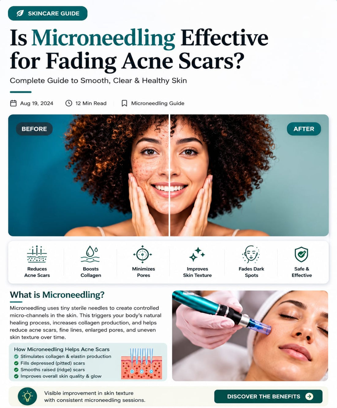 Is Microneedling Effective for Fading Acne Scars? Complete Guide for Clearer Skin